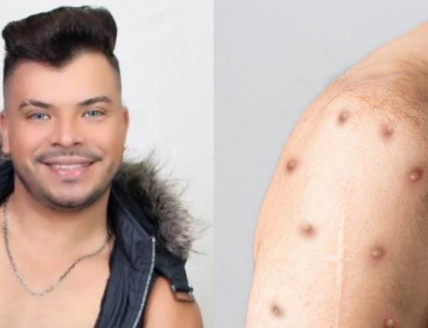 Fotos de cantor paraense que faleceu devido a Mpox viralizam na semana em que o Brasil atinge 90 casos